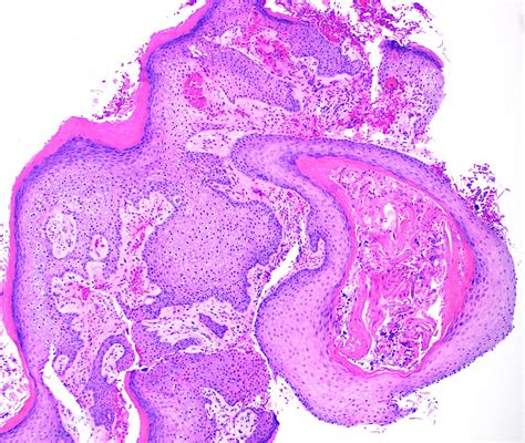 Oral Squamous Cell Carcinoma Histology