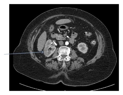 Ct Abdomen And Pelvis With And Without Contrast Renal Protocol Download Scientific Diagram