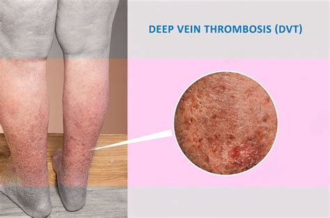 Unveiling Deep Vein Thrombosis Causes Treatment And The Essential