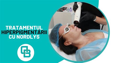 Laser Nordlys Impotriva Petelor Pigmentare DermaBeauty Clinique YouTube