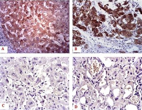 Expression Pattern Of C Flip In Human Hcc Specimens And Corresponding Download Scientific