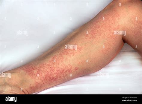 Strong Allergic Rashes On The Leg Impaired Immunity And Reaction To Allergenic Products