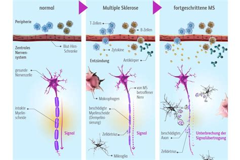 Multiple Sklerose Therapie Symptome Verlauf Ursachen