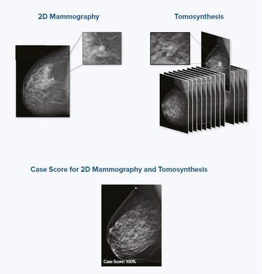 Profound Ai For D Mammography Icad