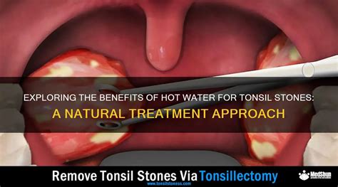 Exploring The Benefits Of Hot Water For Tonsil Stones A Natural Treatment Approach Medshun