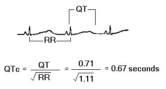 Long QT interval