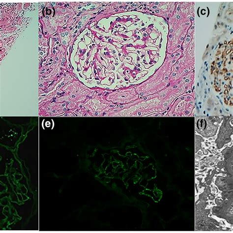 Renal Pathology Of The Proband A Slight Proliferation In Glomerular