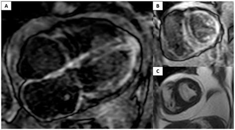 Nephrogenic Systemic Fibrosis Gadolinium