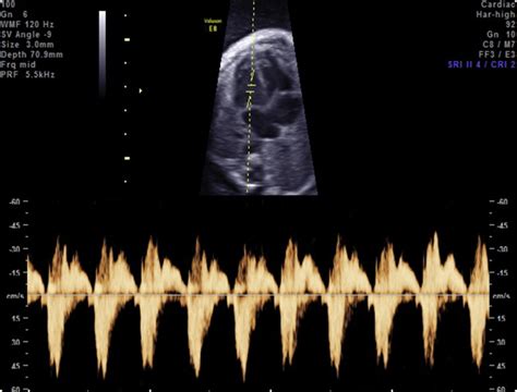 Ultrasonographic Approach To Diagnosis Of Fetal Inflammatory Response