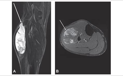 Scielo Brasil Leg Myxoid Liposarcoma Correlation Between Image And