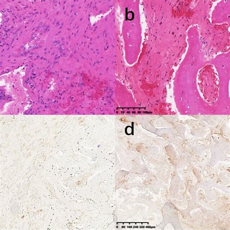 Histopathological Examination Showed The Fibrous Connective Tissue