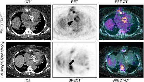 Respective Performance Of 18F FDG PET And Radiolabeled Leukocyte