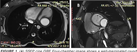 Pdf Left Ventricular Myocardial Hydatid Cyst Semantic Scholar