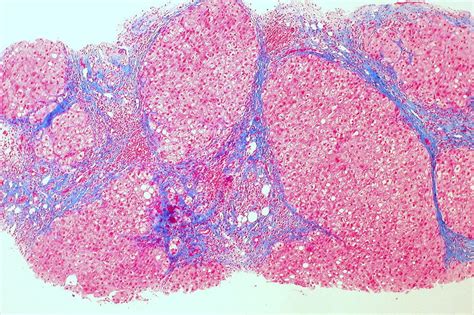 ASSCAT Asociación Catalana de Pacientes Hepáticos