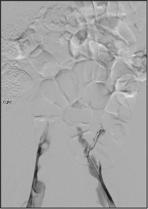 Revascularization Of Acute Inferior Vena Cava Thrombosis And Atresia In