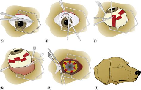 Enucleation Of The Eye