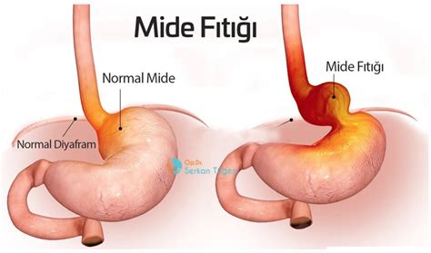 Hiatus Hernia Mide Fıtığı Ameliyatı Opr Dr Serkan Tüğen