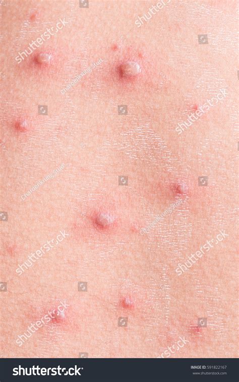 Chicken Pox Rash Viral Infections Chickenpox Stock Photo 591822167 ...