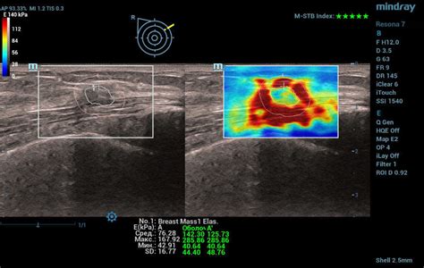 Ultrasound Journal 24 Multiparametric Ultrasound In Differential