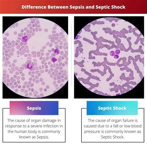 Sepsis Vs Septic Shock Difference And Comparison