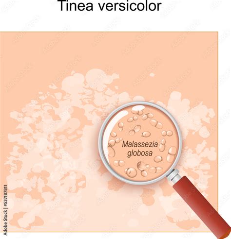 Tinea versicolor. Human skin, Malassezia globosa fungus under a ...