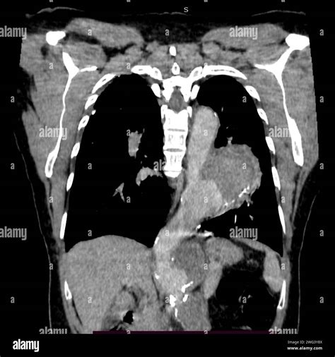 Contrast Chest Computed Tomography CT Scan Of 54 Year Old Female