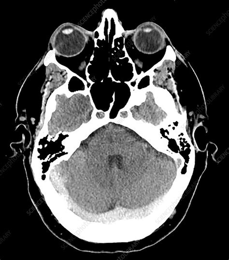 Extensive Dural Sinus Thrombosis, CT - Stock Image - C036/5117 ...