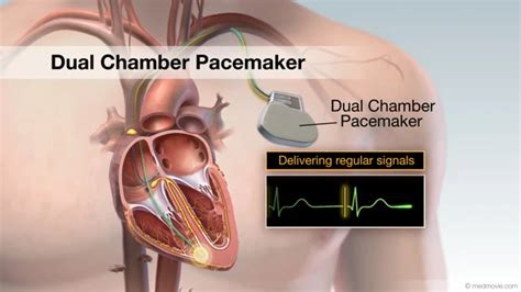 Dual Chamber Pacemaker Ecg