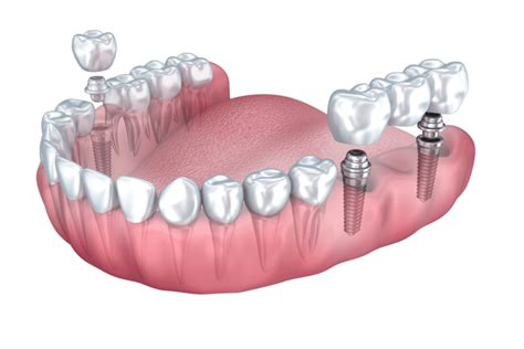 Dental Implants Plano TX | Teeth Implants North Dallas