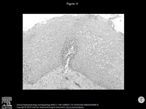 Eosinophilic Esophagitis: A 10-Year Experience in 381 Children - ppt ...