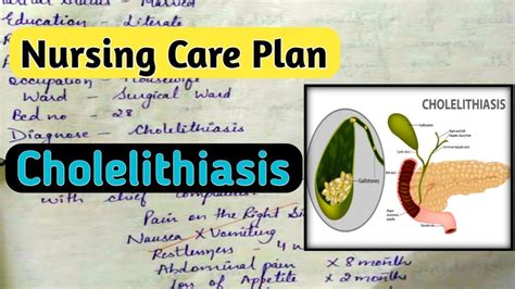 Nursing Care Plan On Cholelithiasis Nursingcriteria YouTube