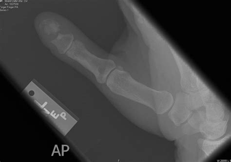 Thumb X-Rays of Ray's Thumb November 2006