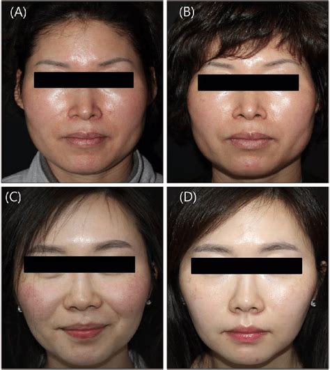 Two Representative Cases Of Clinical Photographs A And C Before Download Scientific