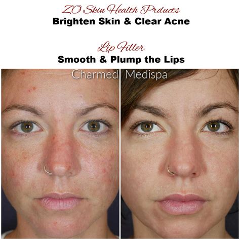 Management Of Acne Pigmentation And Acne Scarring Charmed Medispa