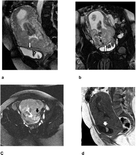 Reliability Of Magnetic Resonance Imaging In Diagnosis And Assessment