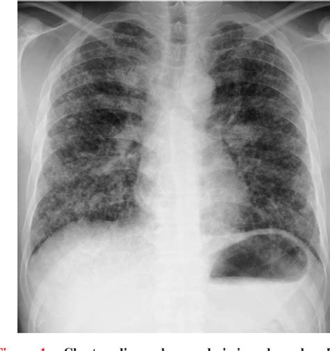 A Patient With Pulmonary Lymphangitic Carcinomatosis Successfully Treated With Ts 1 And