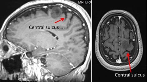 Central sulcus – Radiology Cases