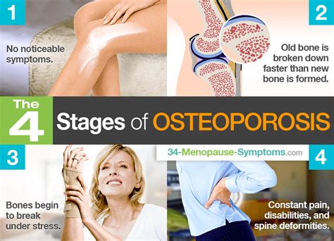 The 4 Stages Of Osteoporosis Artofit