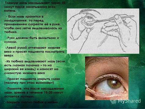 Как правильно закладывать глазную мазь?