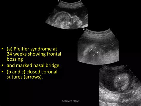 6 Fetal Skull Dr Ahmed Esawy Ppt