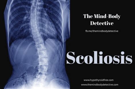 Investigating Scoliosis – META-Healthy Life