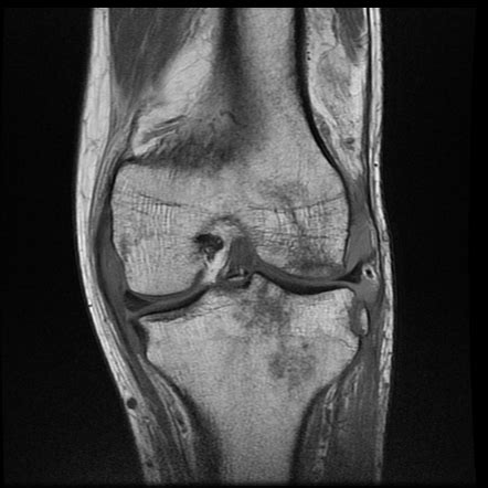 Segond fracture | Radiology Case | Radiopaedia.org