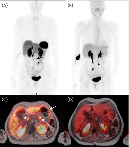 68GaDOTATOCPET MRI And 11C5HTPPET MRI Are Superior To 68GaDOTATOC