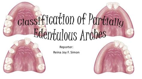 Classification Of Partially Edentulous Teeth