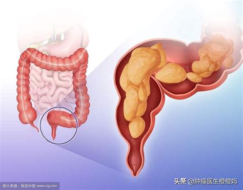 便血除了是痔瘡或癌症，還見於哪些疾病，醫生教您一一鑑別 每日頭條