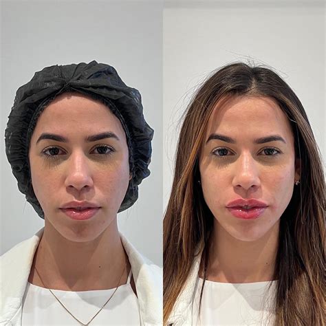 Ex Bbb Larissa Tom Sia Mostra Antes E Depois De Harmoniza O Facial