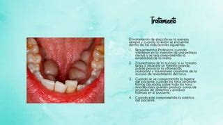 Torus Palatino Y Mandibular PPT