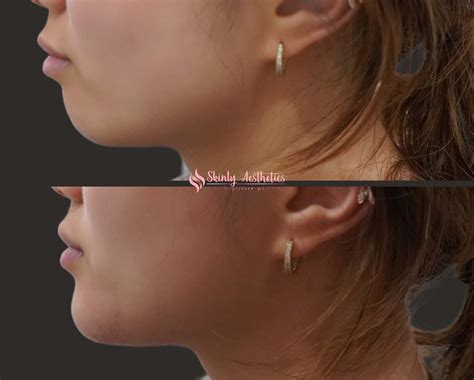 Chin Fillers Before After Results At Skinly