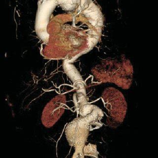 Concurrent thoracic aneurysm (descending aorta) and infrarenal | Download Scientific Diagram