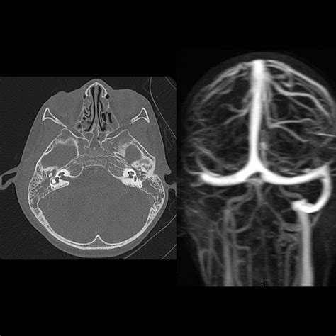 Cavernous Sinus Thrombosis Mrv